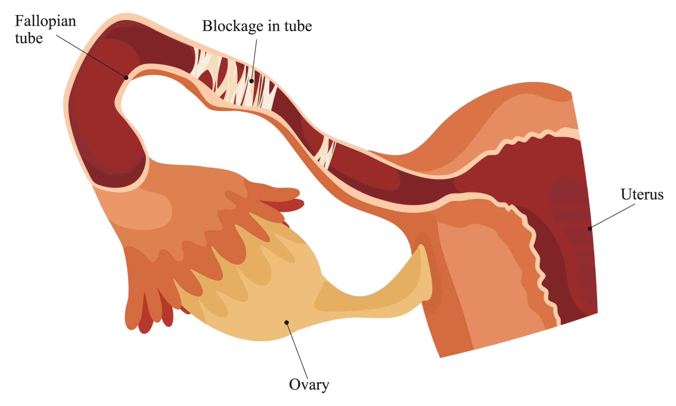 Blocked Fallopian Tube: Causes, Treatment & Fertility | AFGC