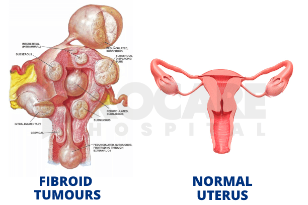 Fibroids and in-vitro fertilization (IVF): Treatment Outcomes | AFGC