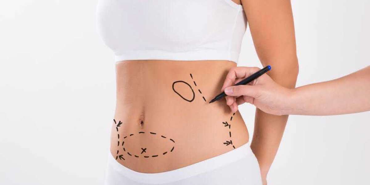 Legal and Ethical Considerations in Liposuction Surgery